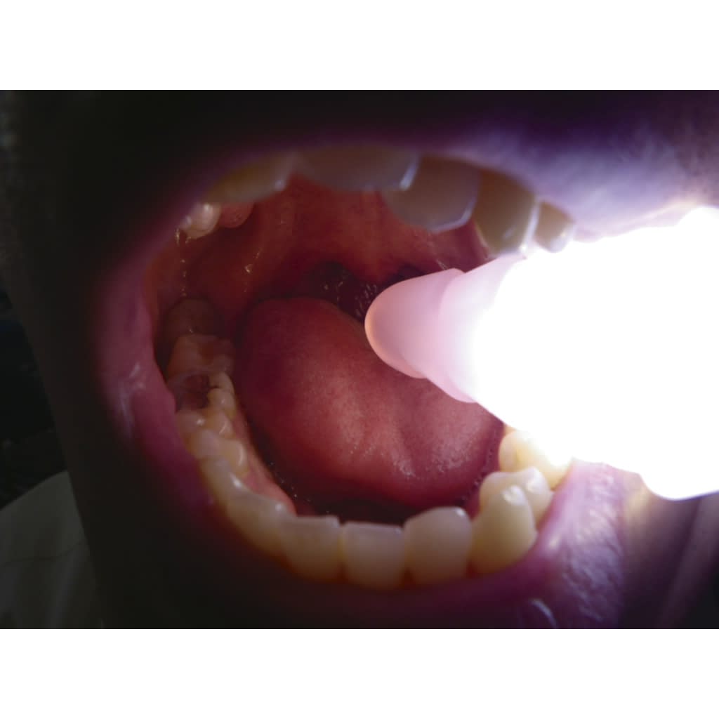 Bite Lock II (hard) II Hard (Blue) Mouth Opening Aid 24-2996-01 Dent Care DC-60 (Blue)