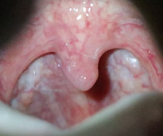 医療用咽頭ライト NIES 1本