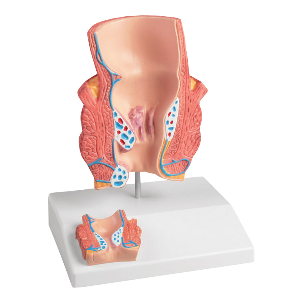 Hemorrhoid model K227 1pc