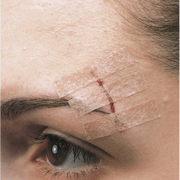 스테리 스트립 스킨 톤 피부 접합용 테이프 25-3103-00 쓰리엠 재팬 B1551(6X75)