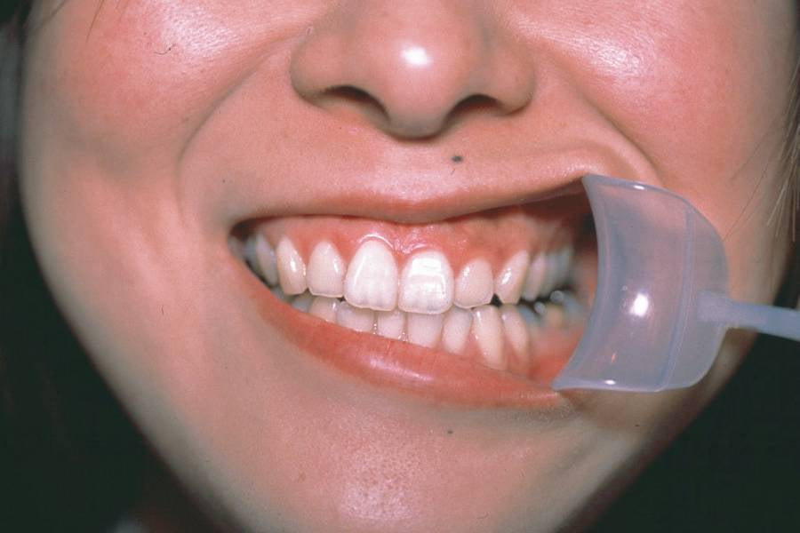 Zyco International Ink Lip Opener Wider C-V Pink