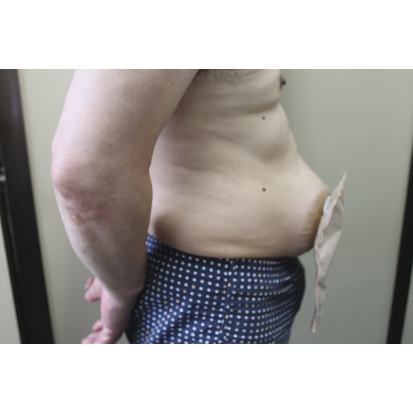 Hernia Abdominal Band Shimal Fine Hernia Band 24-2181-00 Mimuro 4030mm (M)