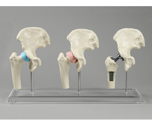 Hip joint implant surgery explanation model 1115 1 set