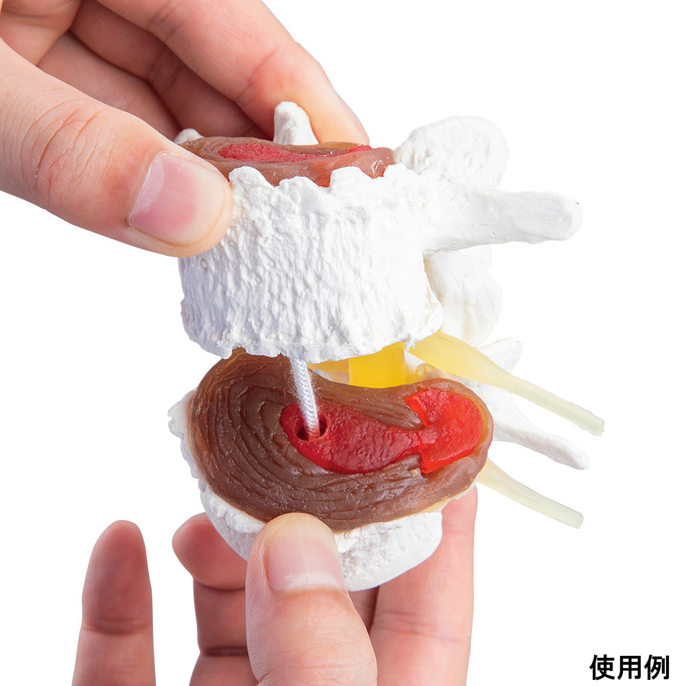 Intervertebral disc degeneration model 7577 1 piece