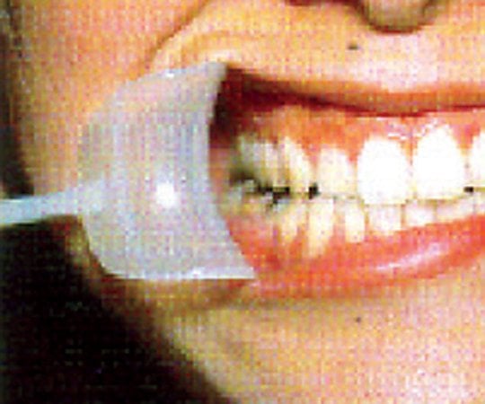 Mouth opening device Wider Chibi White 1 piece