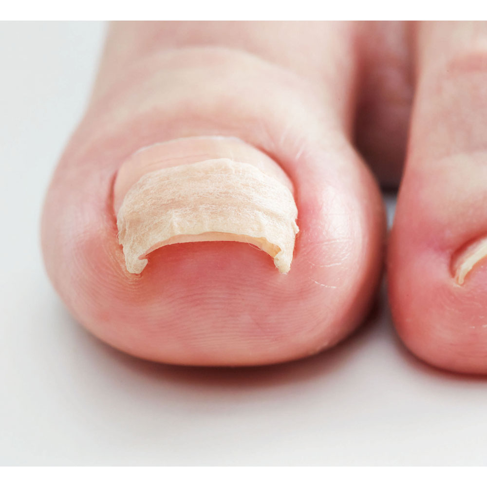 巻爪ケア プロサポートシール 医療用テープ 80枚入 1 個